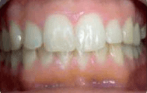 Mike's smile transformation