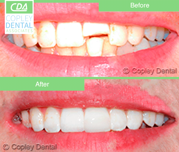 CASE # 1: Emergency Treatment - Fractured Tooth