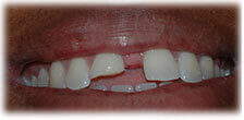CASE #21: Emergency Treatment - Fractured Tooth (before)