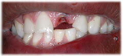 CASE #34: Emergency Treatment - Fractured Tooth (before)