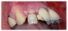 CASE #37: Broken / fractured tooth (before)