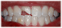 CASE #39: Emergency Treatment - Broken tooth (before)