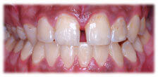 After - CASE # 4: General and Cosmetic Dentistry - Cleaning - Teeth Whitening