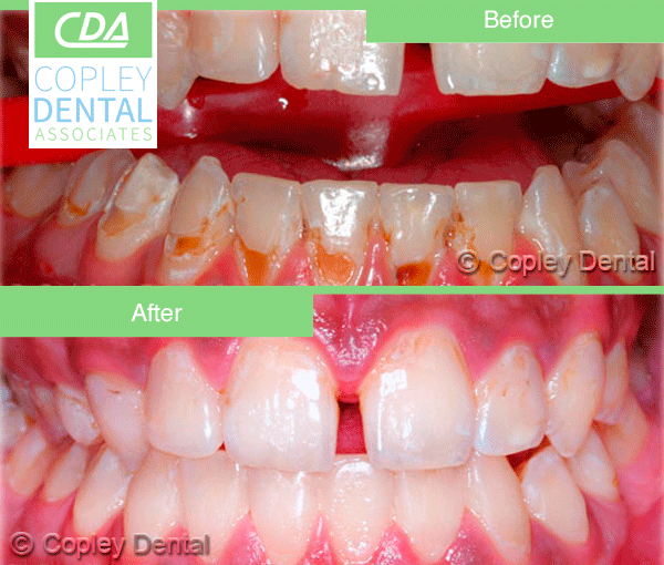 CASE # 4: General and Cosmetic Dentistry - Cleaning - Teeth Whitening