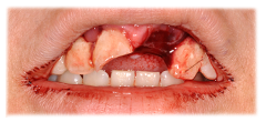 CASE #41: Emergency Treatment - Fractured Tooth (before)