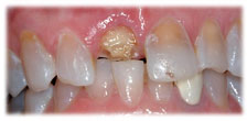 Before - CASE # 5: Emergency Treatment - Fractured or Broken Tooth
