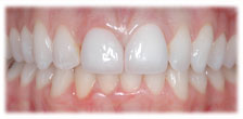 After - CASE # 6: Cosmetic Dentistry - All-Porcelain Crowns