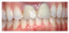 Before - CASE # 6: Cosmetic Dentistry - All-Porcelain Crowns