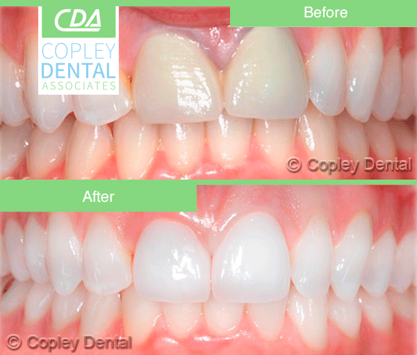 CASE # 6: Cosmetic Dentistry - All-Porcelain Crowns