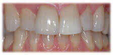 Veneers - Stained Teeth after