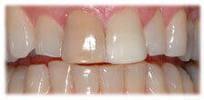 Veneers - Stained Teeth before